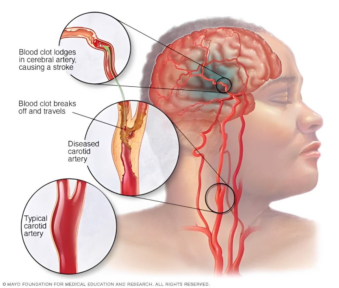 Kesan Terapi Bekam Kepada Anggota Tubuh Selepas Strok