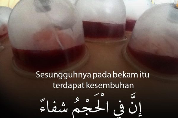 rawatan-alternatif-bekam